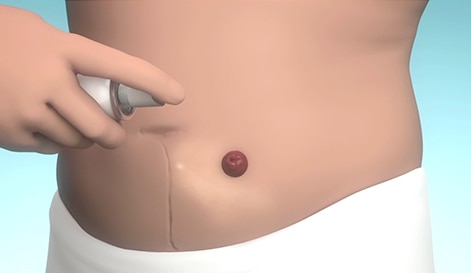 Applying skin barrier spray to protect skin around stoma