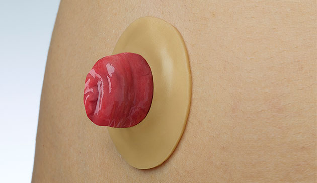 Brava® Protective Seal around the stoma