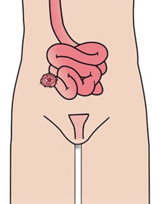 Che cos’è un’ileostomia terminale?