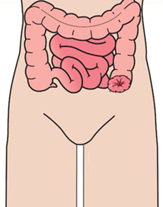 permanente colostoma