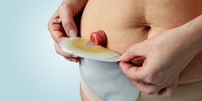 applying SenSuraMio2 ostomy pouch