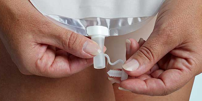 SenSura Mio Convex. Draining the ostomy pouch.