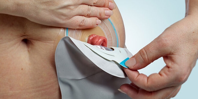 Changing and emptying your ileostomy pouch