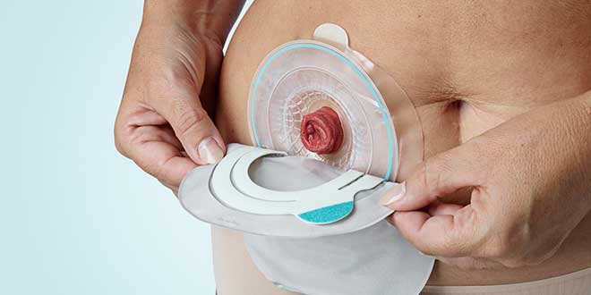 https://www.coloplastcare.com/siteassets/2.-routines/r1_establishing-sound-routines/r1.3-changing-your-colostomy-pouch/R1.3_article.jpg