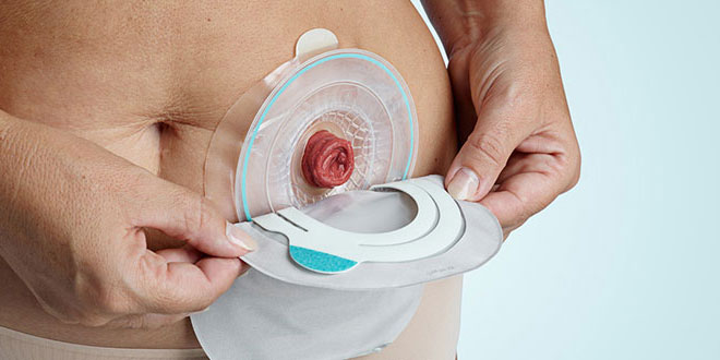 control skin around ostomy