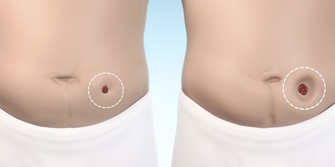 Change in size or length to your stoma