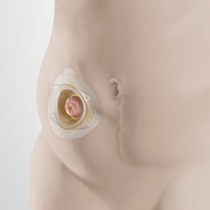 stoma appliance for inward body profile