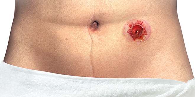 irritated skin around stoma