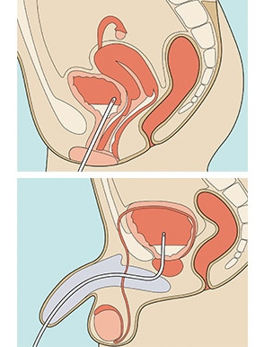 카테터 삽입 방법